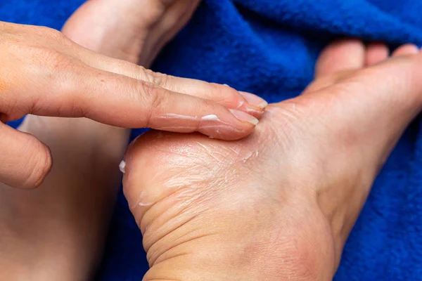 applying cream on the feet sole for the treatment of corn, callus, callosity, cracks, softening the skin, cosmetic procedures