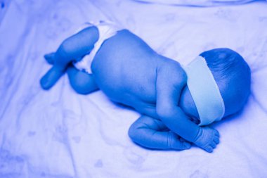 Ultraviyole ışık altında sarılık tedavisi gören yeni doğmuş bir bebek sarılık seviyesini düşürmek için mavi ışıkta yatan yüksek seviyedeki bilirubine sahiptir. Güvenli tıbbi prosedürler