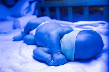Ultraviyole ışık altında sarılık tedavisi gören yeni doğmuş bir bebek sarılık seviyesini düşürmek için mavi ışıkta yatan yüksek seviyedeki bilirubine sahiptir. Güvenli tıbbi prosedürler