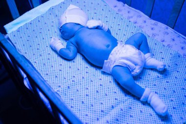 Ultraviyole ışık altında sarılık tedavisi gören yeni doğmuş bir bebek sarılık seviyesini düşürmek için mavi ışıkta yatan yüksek seviyedeki bilirubine sahiptir. Güvenli tıbbi prosedürler
