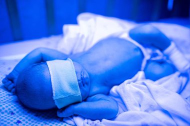 Ultraviyole ışık altında sarılık tedavisi gören yeni doğmuş bir bebek sarılık seviyesini düşürmek için mavi ışıkta yatan yüksek seviyedeki bilirubine sahiptir. Güvenli tıbbi prosedürler