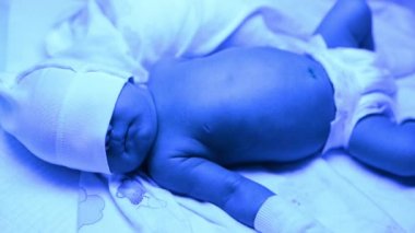 Ultraviyole ışık altında sarılık tedavisi gören yeni doğmuş bir bebek sarılık seviyesini düşürmek için mavi ışıkta yatan yüksek seviyedeki bilirubine sahiptir. Güvenli tıbbi prosedürler