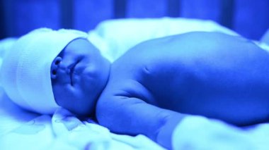 Ultraviyole ışık altında sarılık tedavisi gören yeni doğmuş bir bebek sarılık seviyesini düşürmek için mavi ışıkta yatan yüksek seviyedeki bilirubine sahiptir. Güvenli tıbbi prosedürler
