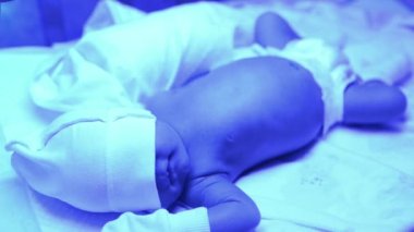 Ultraviyole ışık altında sarılık tedavisi gören yeni doğmuş bir bebek sarılık seviyesini düşürmek için mavi ışıkta yatan yüksek seviyedeki bilirubine sahiptir. Güvenli tıbbi prosedürler