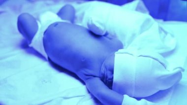 Ultraviyole ışık altında sarılık tedavisi gören yeni doğmuş bir bebek sarılık seviyesini düşürmek için mavi ışıkta yatan yüksek seviyedeki bilirubine sahiptir. Güvenli tıbbi prosedürler