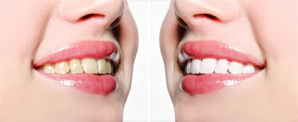 Kobieta Uśmiecha Się Zęby Przed Wybielaniu Koncepcja Opieki Stomatologicznej Zdrowotnej — Zdjęcie stockowe
