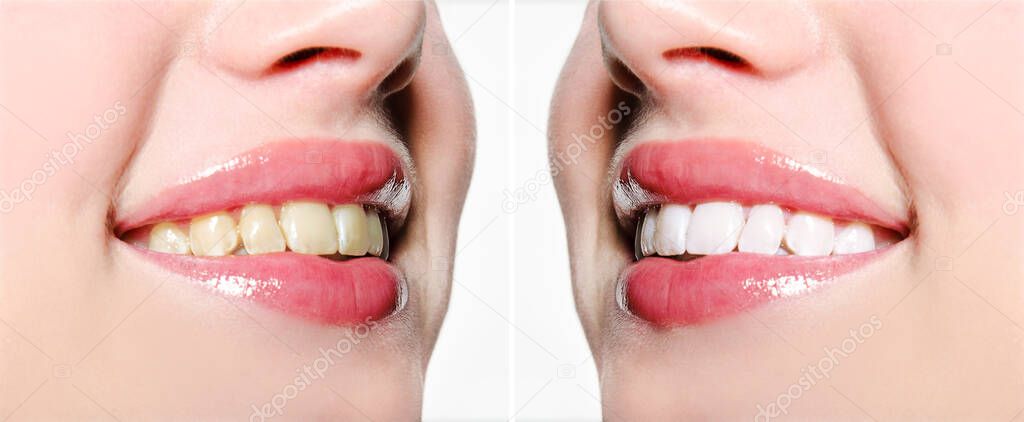 Woman smile teeth before and after whitening. Dental and health care concept