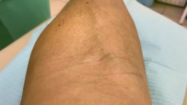 Tıbbi analiz için kan örnekleme için kolundaki damarı delici iğne şırınga