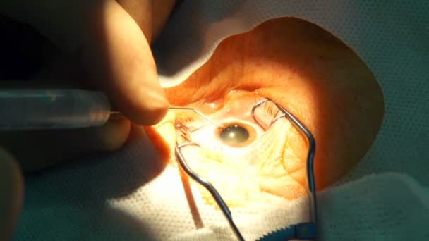 Hands performing eye surgery — Stock Video