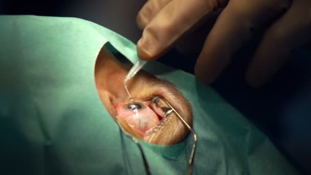 Handen uitvoeren van oogchirurgie — Stockvideo