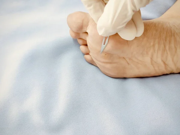 Doktor kontrolü, ayak altında siğil tedavisi ve iyileştirme, salisilik asit tedavisi. siğil vücut verruca donması, sağlık ve tıbbi konsept.