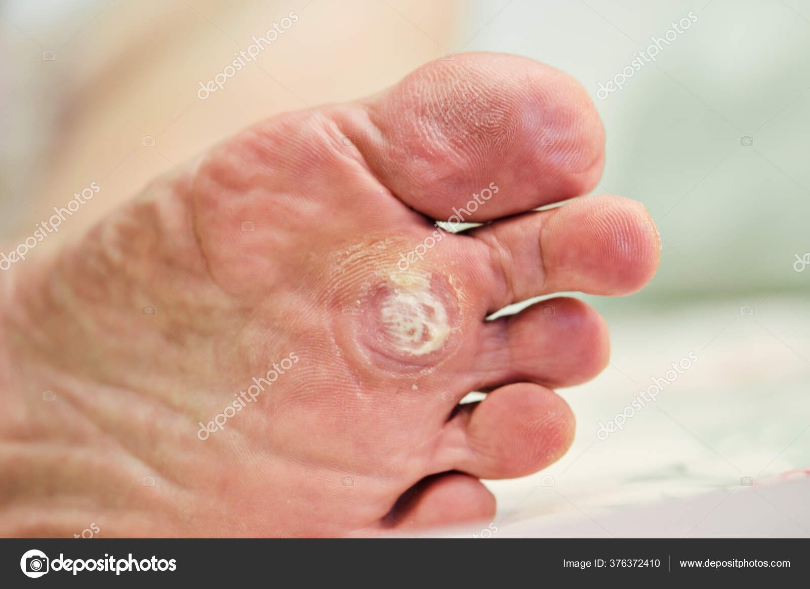 Wart Foot Can Treatment Salicylic Acid Wart Can Treat Treatment Stock Photo By C Tpap28 Gmail Com