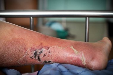 Şeker hastası insanların ayakları, donuk ve şişmiş. Diyabet ve ülserin zehirlenmesi nedeniyle. 