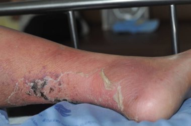 Şeker hastası insanların ayakları, donuk ve şişmiş. Diyabet ve ülserin zehirlenmesi nedeniyle. 