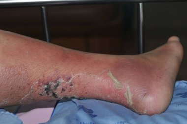 Şeker hastası insanların ayakları, donuk ve şişmiş. Diyabet ve ülserin zehirlenmesi nedeniyle. 