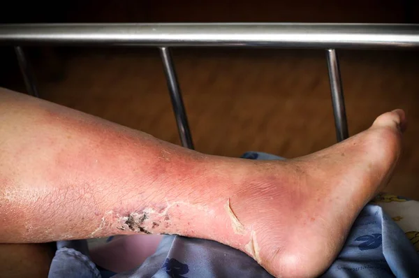 The feet of people with diabetes, dull and swollen. Due to the toxicity of diabetes, ulceration