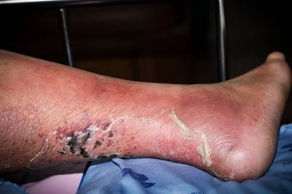 Şeker Hastası Insanların Ayakları Donuk Şişmiş Diyabet Ülserin Zehirlenmesi Nedeniyle — Stok fotoğraf