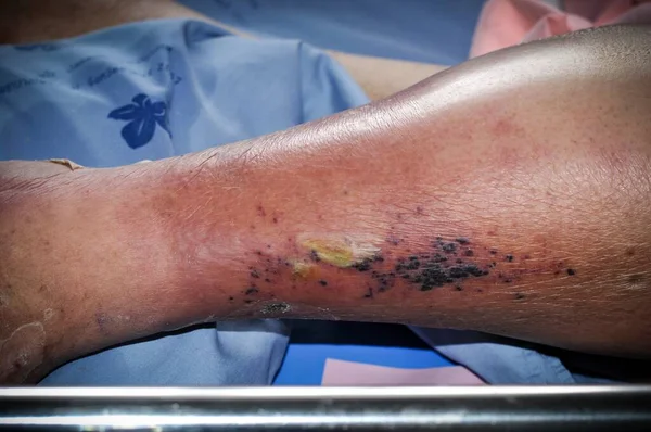 Şeker hastası insanların ayakları, donuk ve şişmiş. Diyabet ve ülserin zehirlenmesi nedeniyle. 