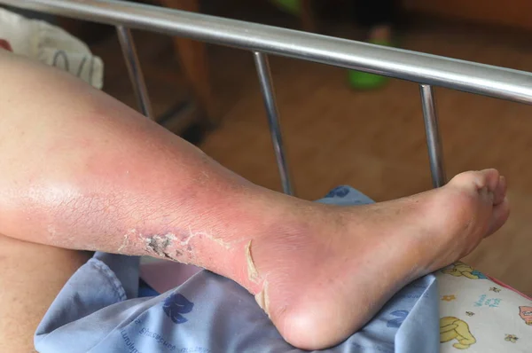 Şeker hastası insanların ayakları, donuk ve şişmiş. Diyabet ve ülserin zehirlenmesi nedeniyle. 