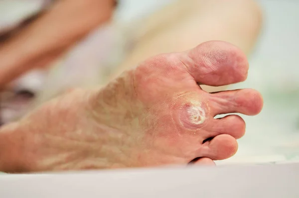 Κονδυλωμάτων Κάτω Από Πόδια Μπορεί Θεραπεία Σαλικυλικό Οξύ Κονδυλωμάτων Μπορεί — Φωτογραφία Αρχείου