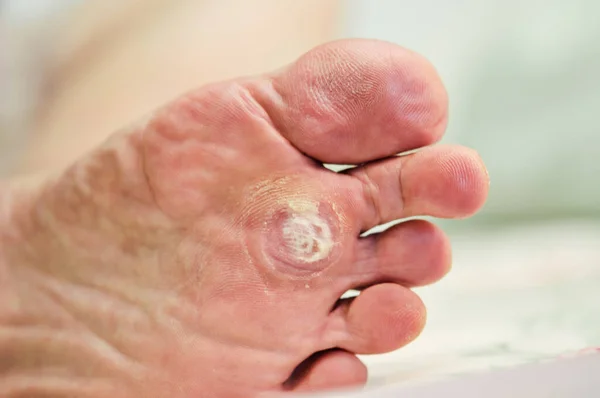 Ayak altındaki siğil salisilik asitle tedavi edebilir. Siğil, salisilik asitle tedavi edebilir. Ayak verruca üzerinde siğil dondurma kavramı bulanık arkaplan, seçici odaklanma,