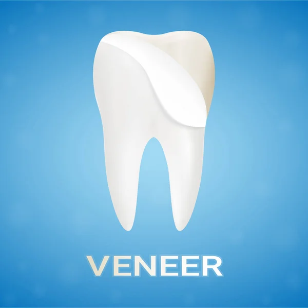 Dental Veneers On A Human Tooth terisolasi di A Background. Ilustrasi Vektor Realistik . - Stok Vektor