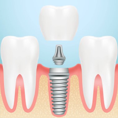 Gerçekçi sağlıklı dişler ve diş implantı. Dental Implant tüm parçaları Crown, ayağına, bir arka plan üzerinde izole vida ile montajı. Vektör çizim.