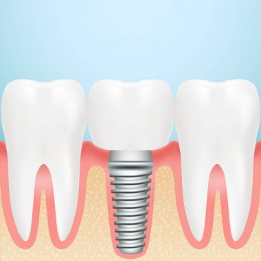 Gerçekçi Dental Implant. Dental Implant tüm parçaları Crown, ayağına, bir arka plan üzerinde izole vida ile montajı. Vektör çizim.