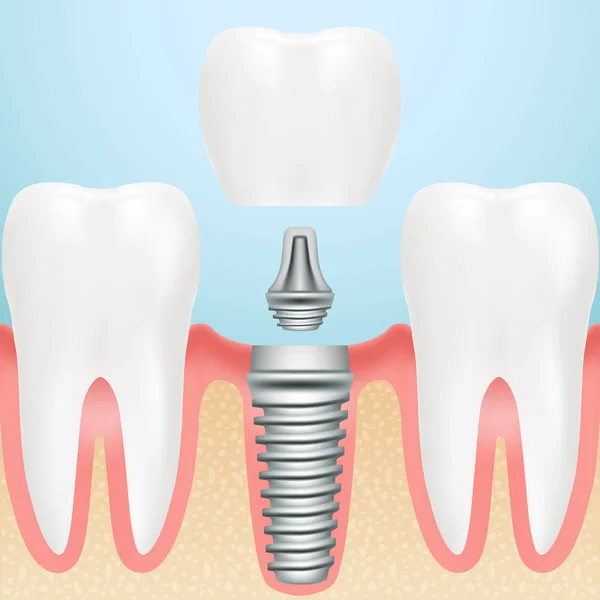 Gerçekçi sağlıklı dişler ve diş implantı. Dental Implant tüm parçaları Crown, ayağına, bir arka plan üzerinde izole vida ile montajı. Vektör çizim.