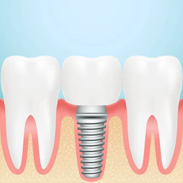 Gerçekçi Dental Implant. Dental Implant tüm parçaları Crown, ayağına, bir arka plan üzerinde izole vida ile montajı. Vektör çizim.