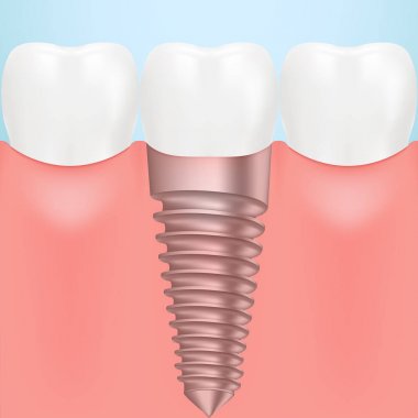 Bir arka plan üzerinde izole insan Implant diş. Vektör çizim.