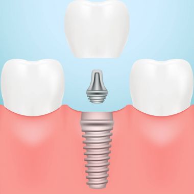 İnsan diş ve Diş implantları bir arka plan üzerinde izole. Vektör çizim.