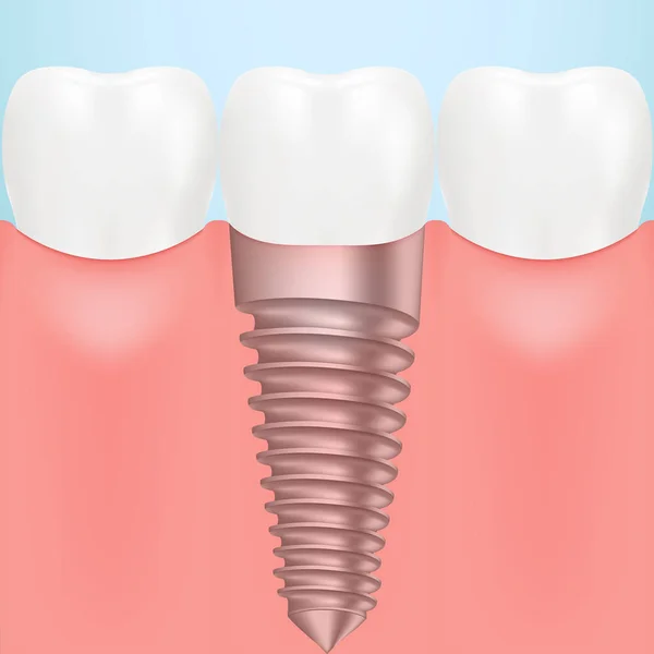 Implante humano dental aislado en un fondo. Ilustración vectorial . — Vector de stock