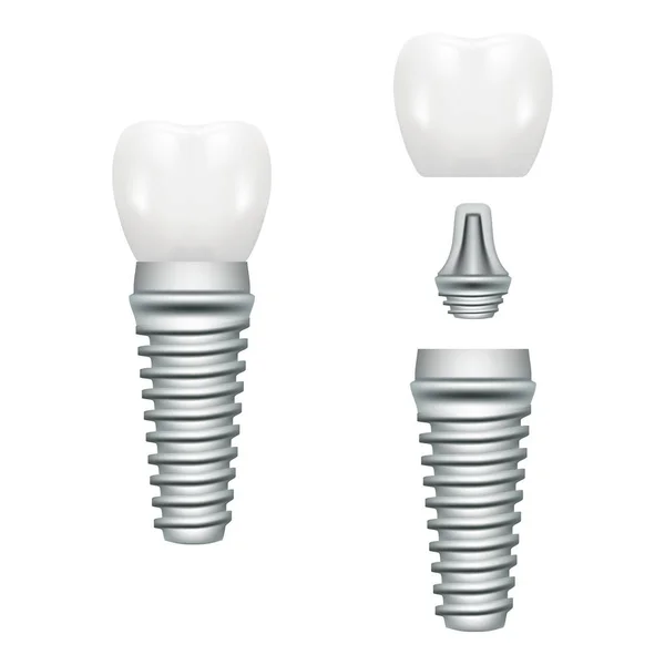 Beyaz bir arka plan üzerinde izole tüm parçaları Crown, ayağına, vida ile gerçekçi Dental Implant yapısı. Vektör çizim.
