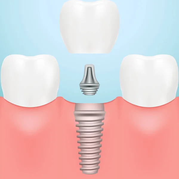 Emberi fogak és fogászati implantátumok elszigetelt a háttérben. Vektoros illusztráció. — Stock Vector