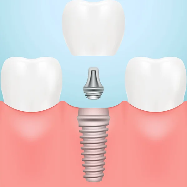İnsan diş ve Diş implantları bir arka plan üzerinde izole. Vektör çizim.