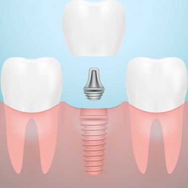 İnsan diş ve diş implantı bir arka plan üzerinde izole. Vektör çizim.
