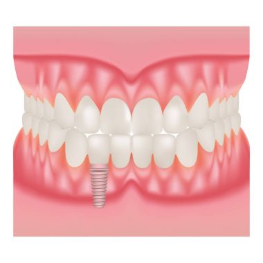 İnsan çene modeli diş ve Implant ile. Diş implantları beyaz bir arka plan üzerinde izole montajı. Vektör çizim.