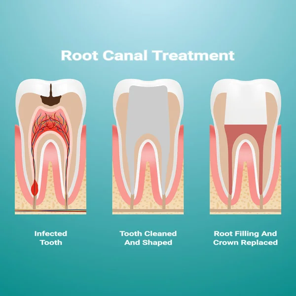 Pulpitis. Root Canal Therapy. Infected Pulp Is Removed From The Tooth And The Space Occupied By It Is Cleaned And Filled With A Gutta Percha Isolated On A Background. Vector Illustration. — Stock Vector