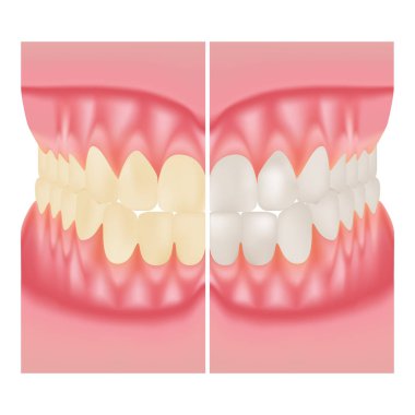 Diş beyazlatma. Diş Bakımı. Önce ve sonra görünümü diş beyazlatma beyaz bir arka plan üzerinde izole. Vektör çizim.