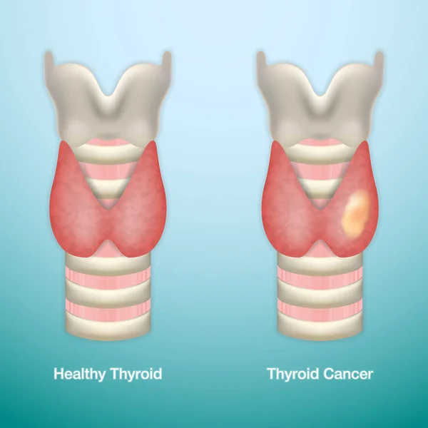 Здоровый рак щитовидной железы и щитовидной железы. Вектор S10 . — стоковый вектор