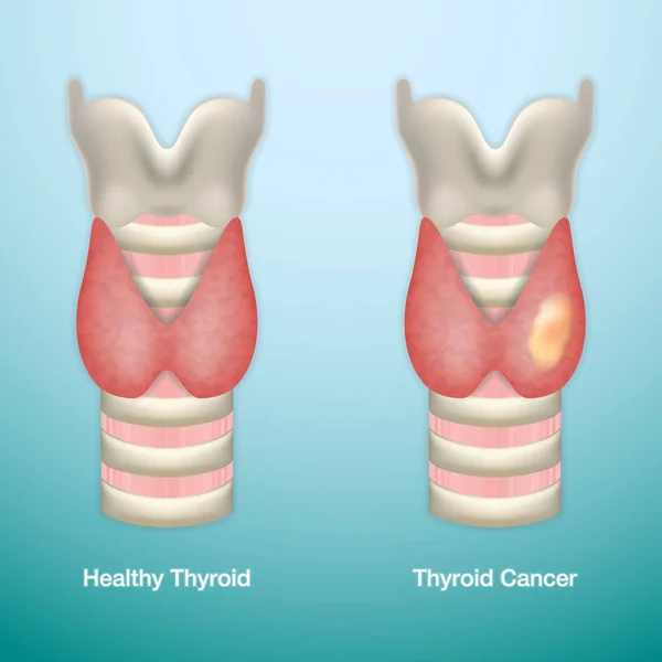 Zdrowej tarczycy i raka tarczycy. Ilustracja wektorowa Eps10. — Wektor stockowy