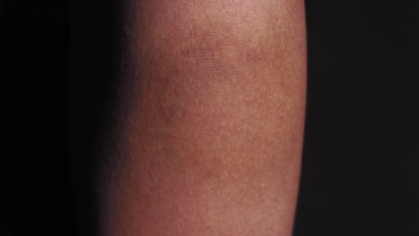 Memar berat dari tangan dari musim gugur. cedera tangan. close-up macro, bruise, bruise, selective focus — Stok Video