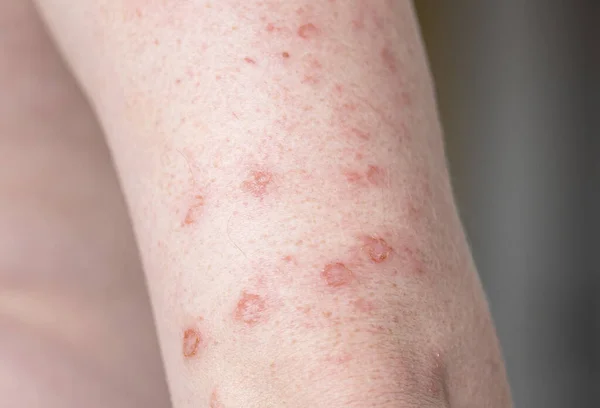 Close Body Allergic Rash Eczema Hands Skin Red Bumps Blisters — Stock Photo, Image