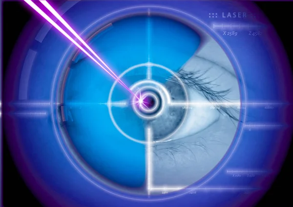 Cirurgia a laser ocular, correção a laser, correções oculares — Fotografia de Stock
