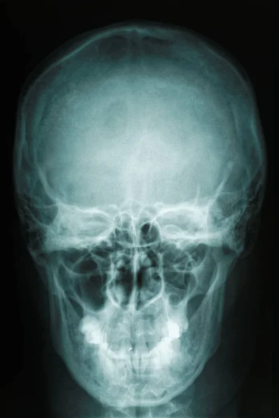 Radiologia radiológica de crânio — Fotografia de Stock