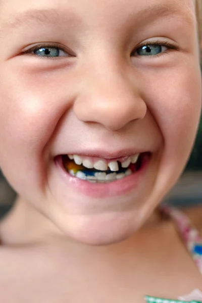 Niña con aparato de ortodoncia y diente tambaleante —  Fotos de Stock