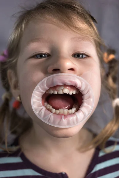 Dientes permanentes para adultos delante de los dientes de leche del niño : —  Fotos de Stock