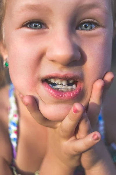 Mała dziewczynka z urządzeniem ortodoncji i krzywym zębami. Wobbl — Zdjęcie stockowe