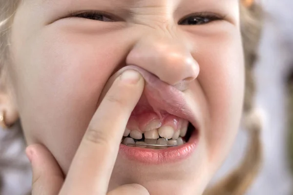 Adultos dentes permanentes que vêm na frente dos dentes de leite da criança : — Fotografia de Stock